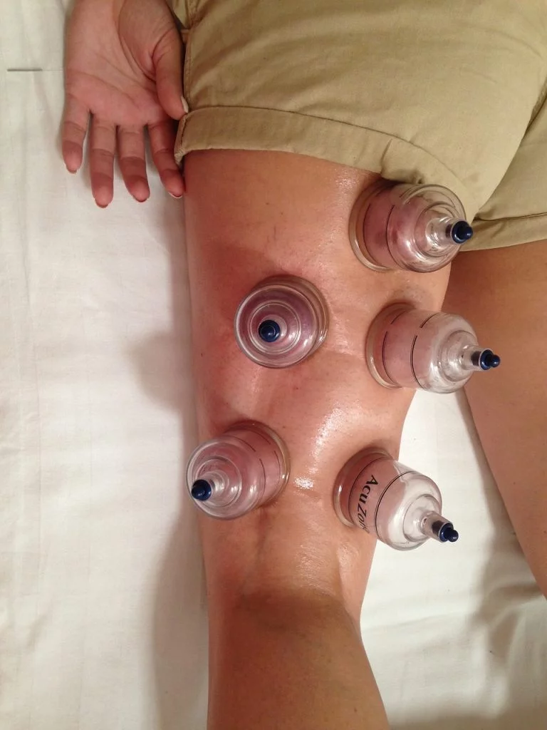 Dry Cupping Therapy